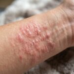 Symptômes de l'histamine