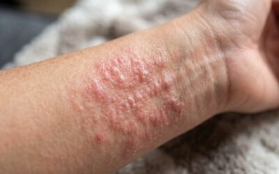 Symptômes de l'histamine