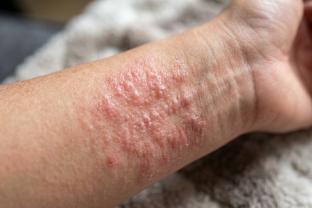 Symptômes de l'histamine